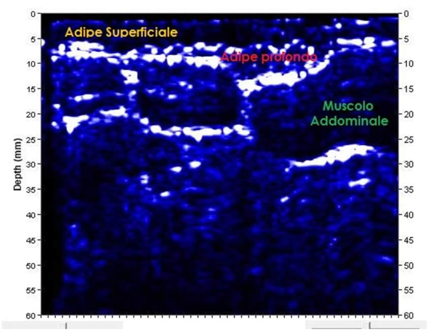 Adipometria